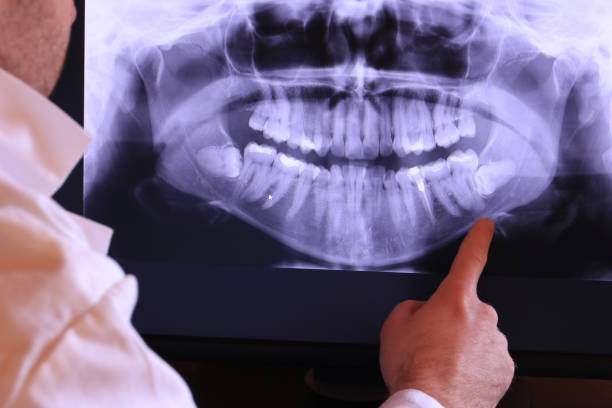 Best Emergency Wisdom Teeth Removal in Buffalo, NY